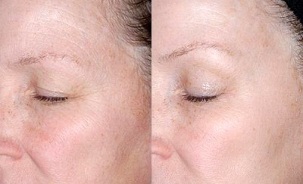 peremajaan kulit di sekitar mata sebelum dan selepas gambar
