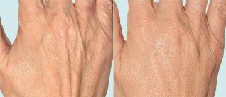 Kulit tangan sebelum dan selepas terapi pecahan