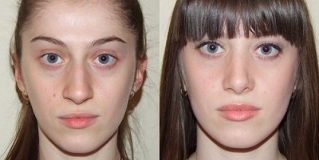 sebelum dan selepas peremajaan kulit plasma